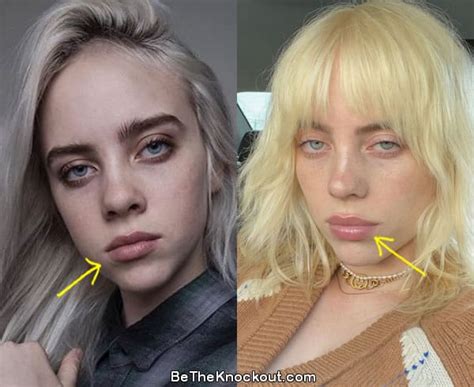 billie eilish plastic surgery|billie eilish before plastic surgery.